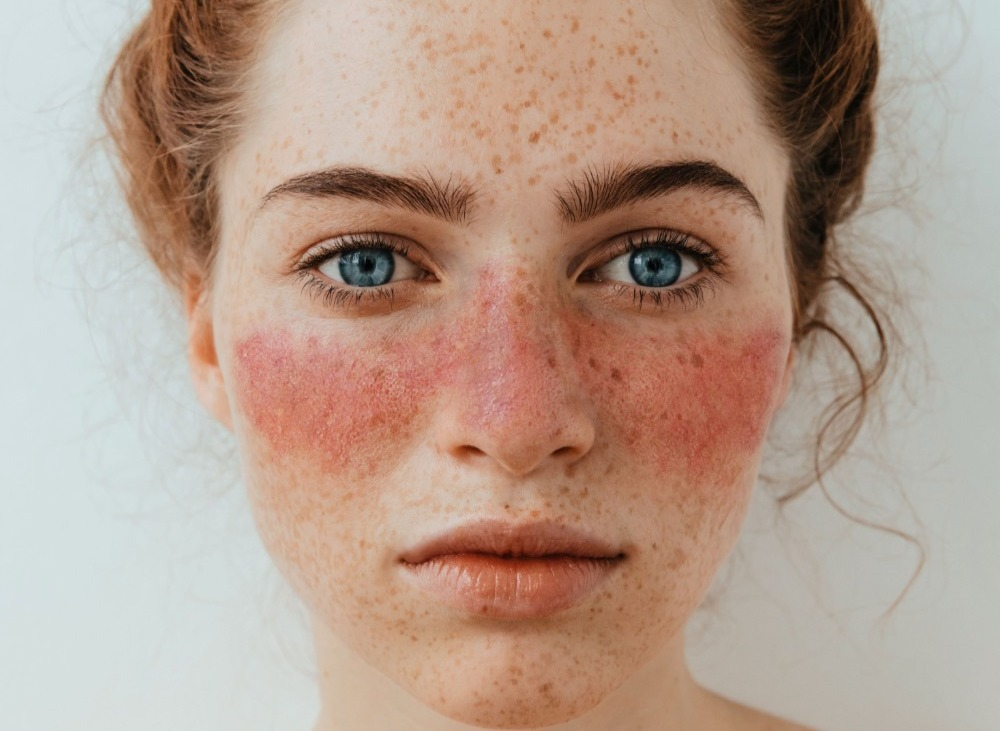 Scientists are finally discovering the cause of lupus 23