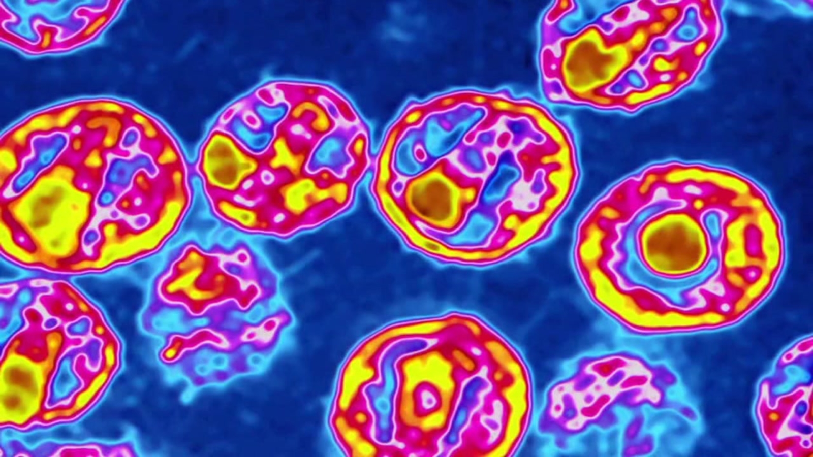 Cured of HIV: 5th person confirmed cured of HIV 3