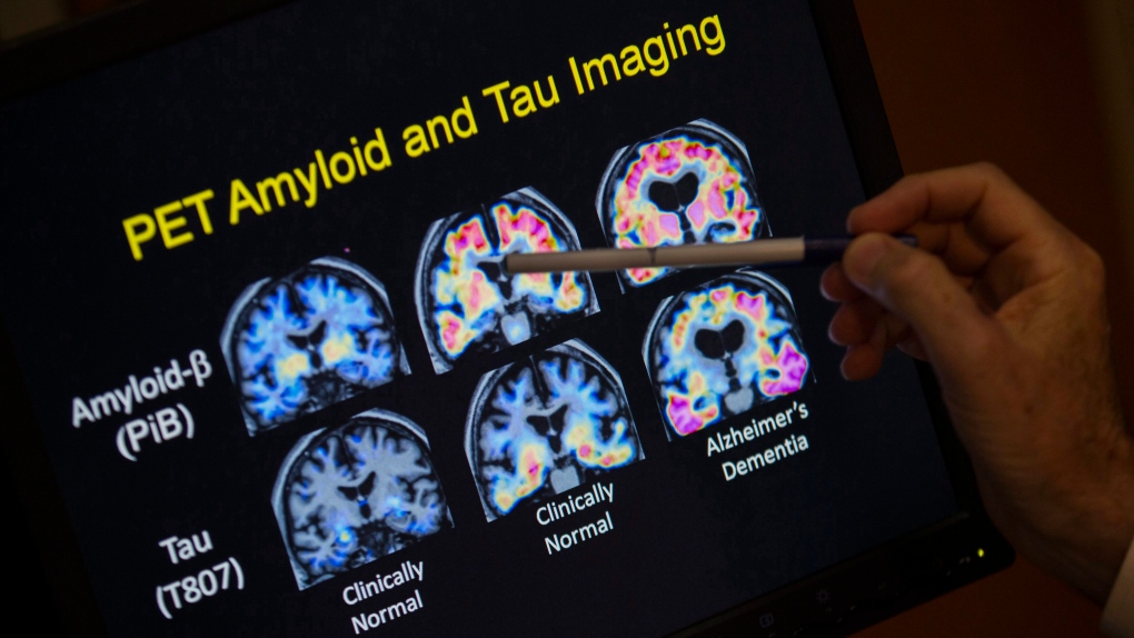 Youngest Alzheimer’s patient diagnosed in China 19