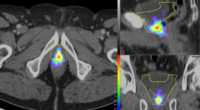 Revolutionizing Prostate Cancer Treatment with PSMA PET