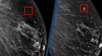 Revolutionary AI Detects Breast Cancer