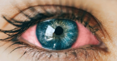 Alzheimer's Retinal Changes: New Discovery